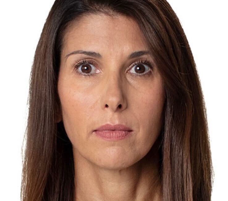 Botox Treatment Result 1 - After
